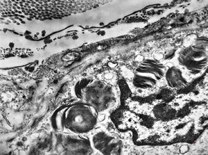 M, 48y. | Fabry disease M, 48y. | Fabry disease